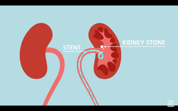 kidney stones and ureteral stents